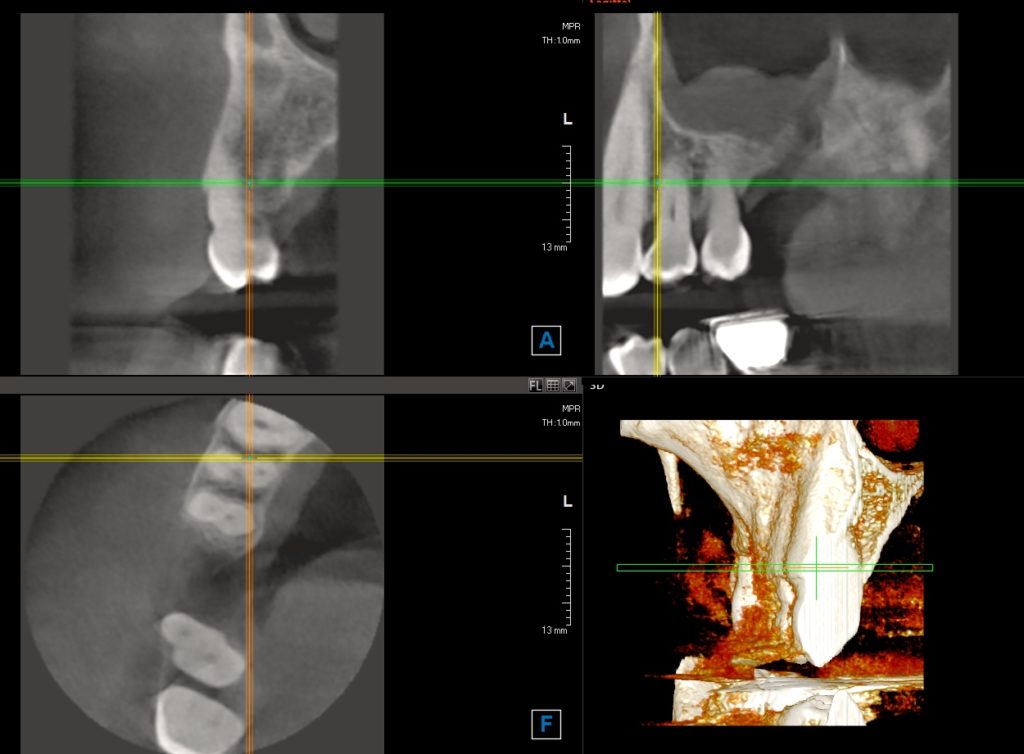 implants dentaires