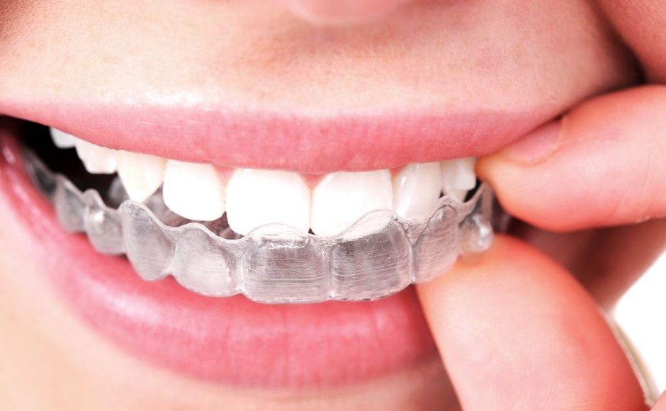 ORTHODONTIE DE L'ADULTE : TECHNIQUE PAR ALIGNEURS (GOUTTIÈRES TRANSPARENTES)